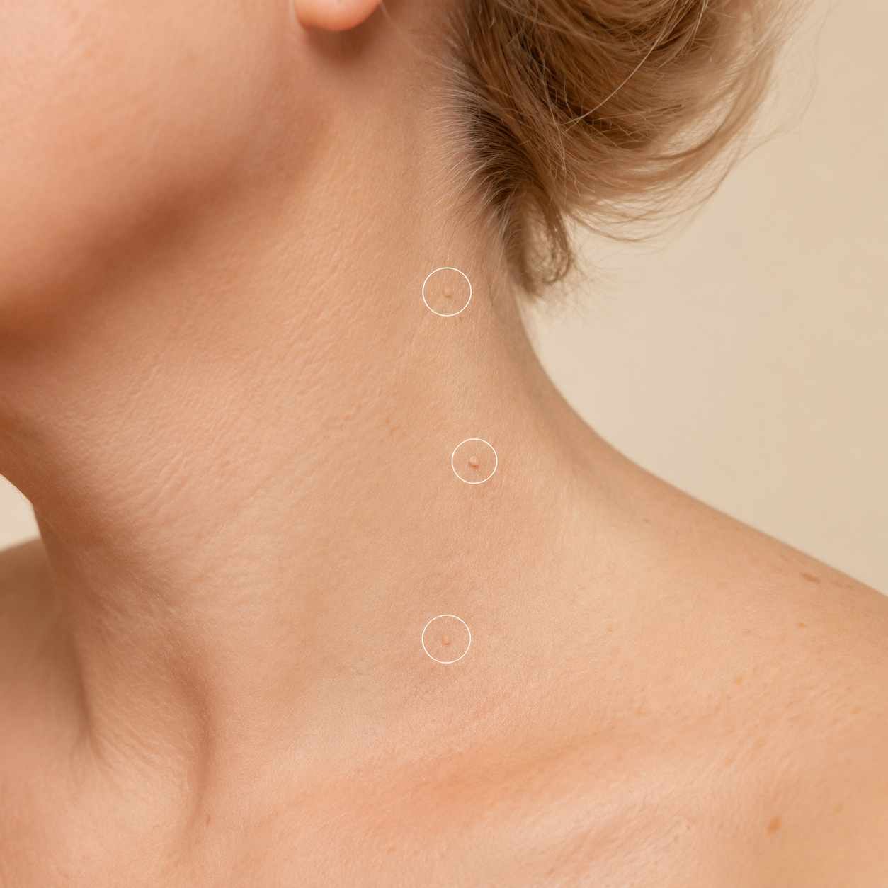 Skin Tag Removal